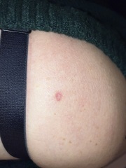 Could this be skin cancer?