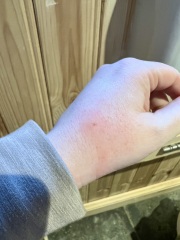 Identify my bites!