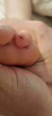 Mark on daughter's toe