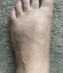 Scary raised veins in feet