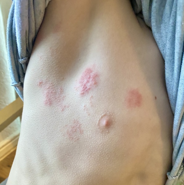 What could this rash be? (Picture included)