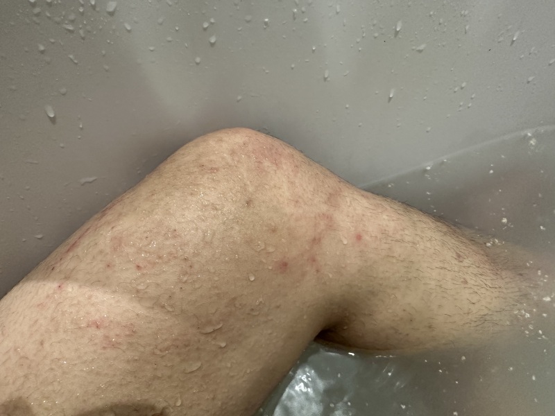Spots/all over rash