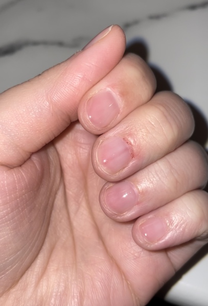 Please read!!! Worried about line on nail