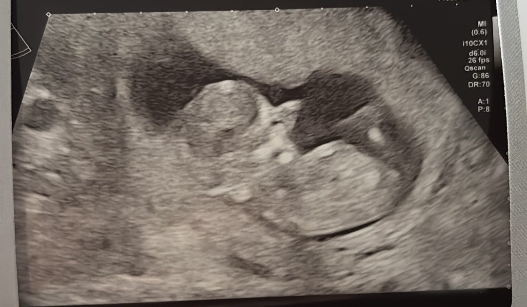 12 week scan has sent me spiralling