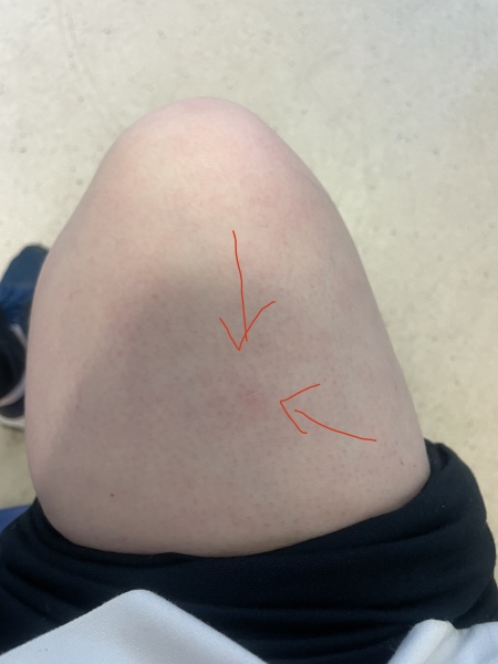 Lump under skin on thigh? Photos included