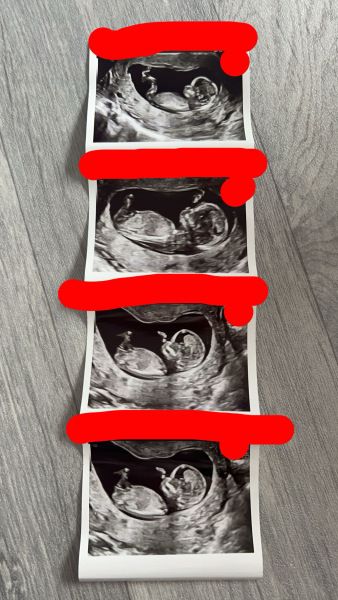 20w Scan - boy or girl?