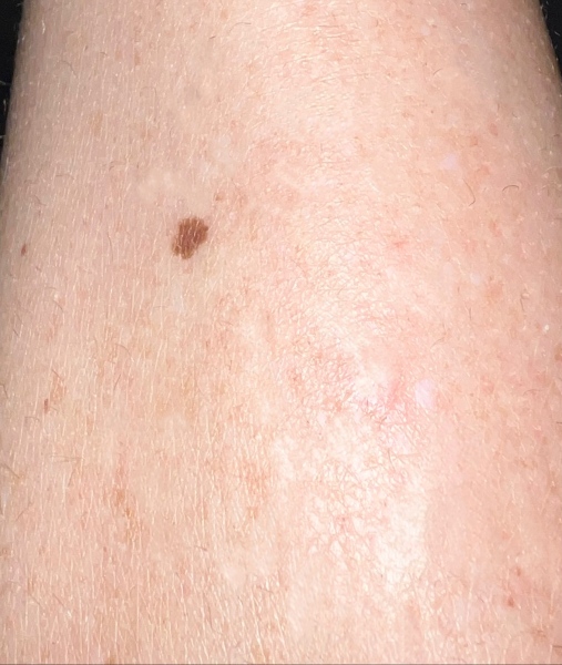 Unusual Freckle