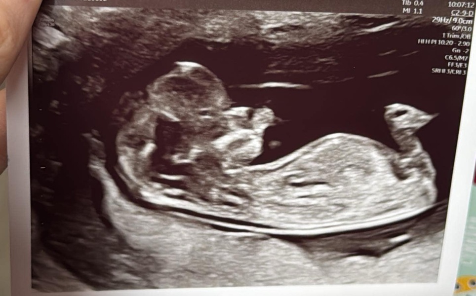 Is the nub visible on my scan