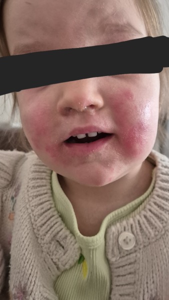 Scarlet Fever?