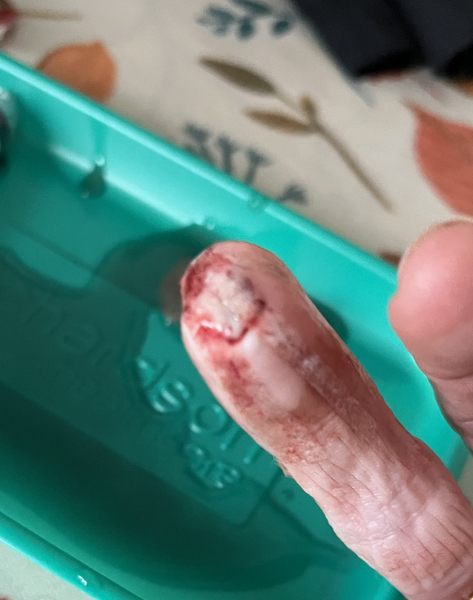 Cut finger - will the tip survive? **TW** Photos