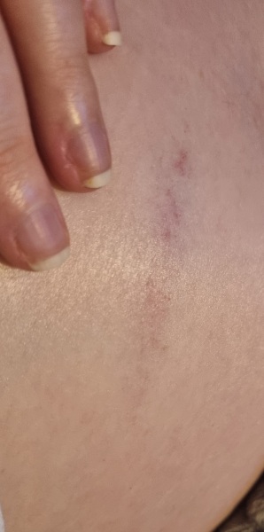 39w bumped into a door, negative blood group