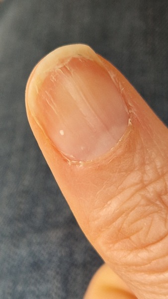 What does my nail say about my health?