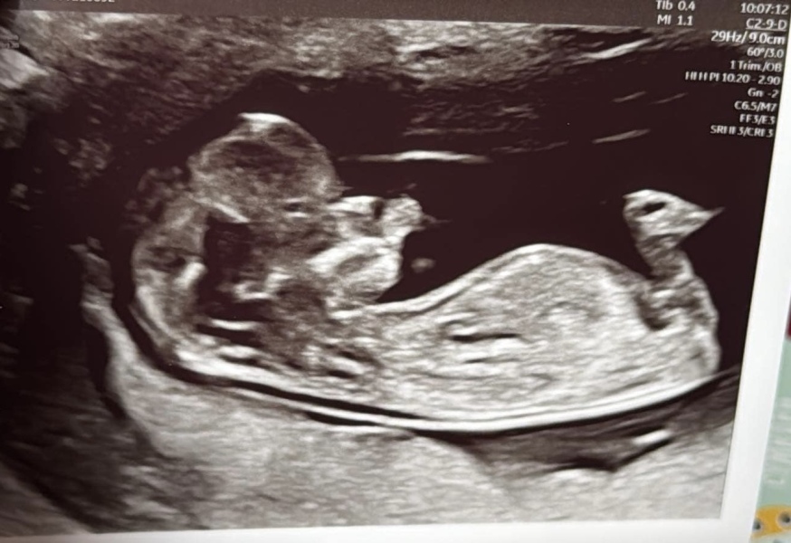 Is the nub on my scan visible?