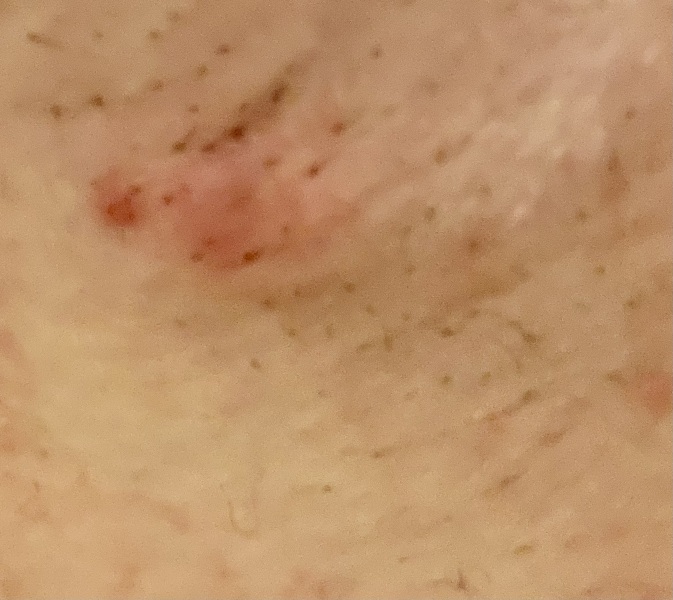 Is this an ingrown hair?