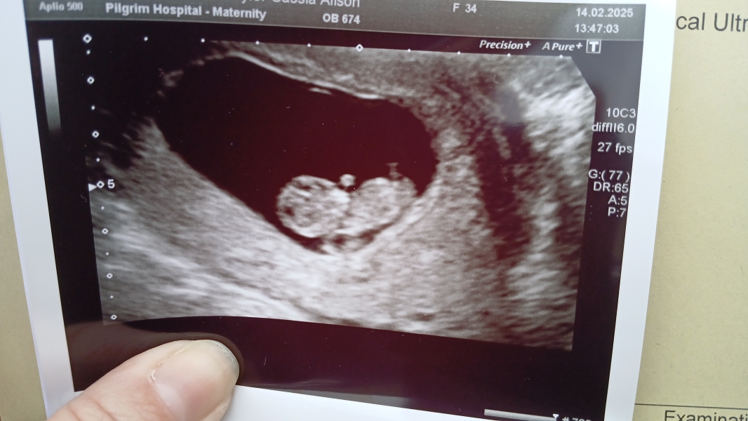 Nub theory at 10 weeks?