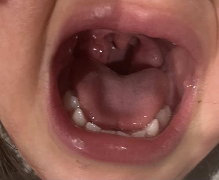 Tonsillitis? (Photo)