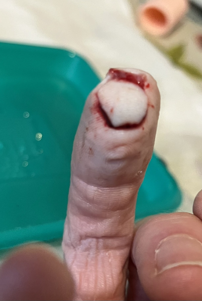 Cut finger - will the tip survive? **TW** Photos