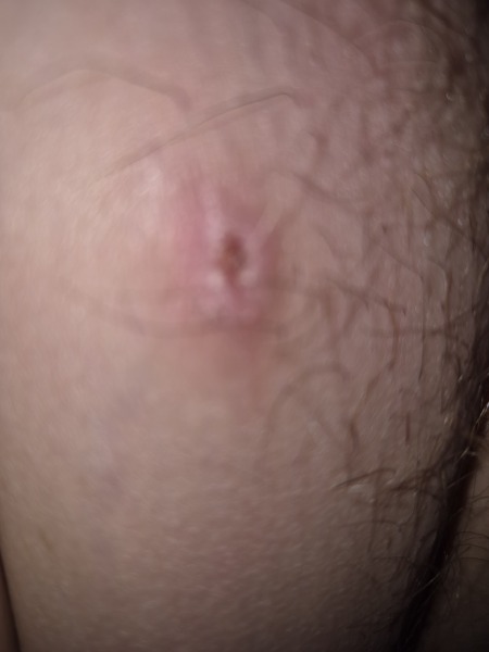 Oh. My. God. This ingrown hair