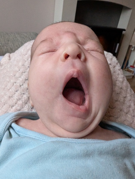 Slight asymmetrical mouth concern