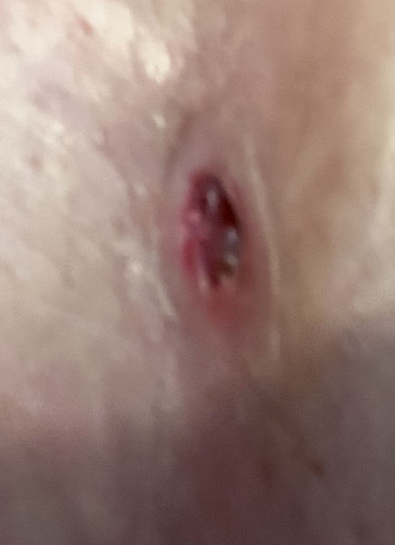 Awkward Cyst