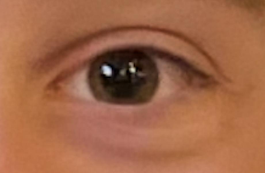 Is this usual? 13 year old with baggy undereyes
