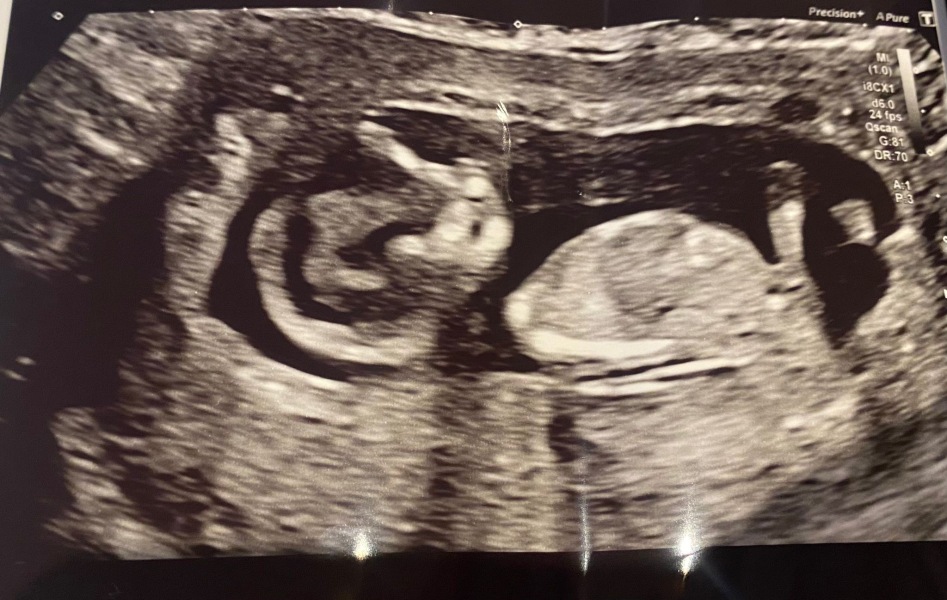 High risk screening-NIPT results worry