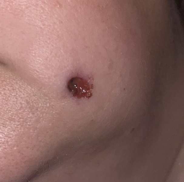 Help, how to stick burst stitches together with steri strips?