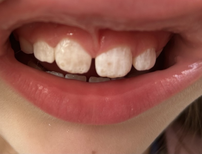 Is this early tooth decay? Photo included
