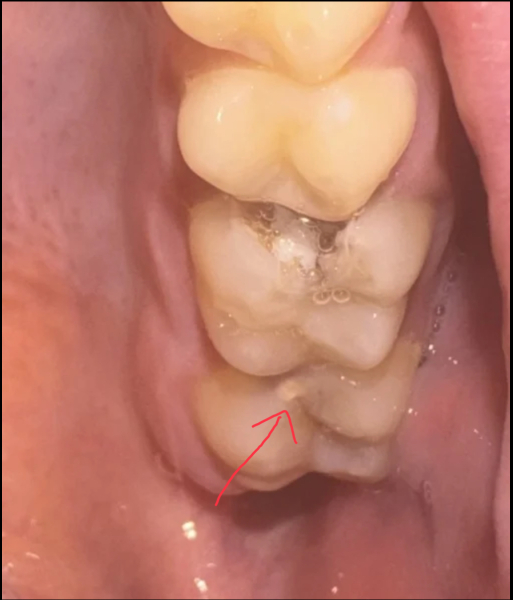 Disgusting pic warning.. but what has happened to my tooth?!
