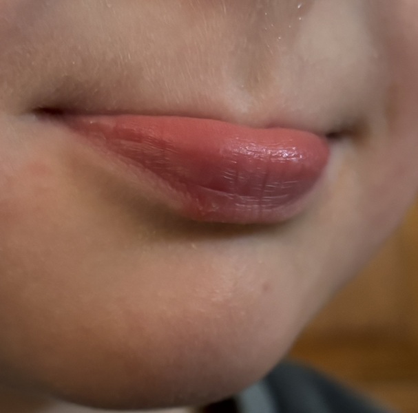 Is this a cold sore?
