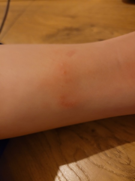 Is this eczema?