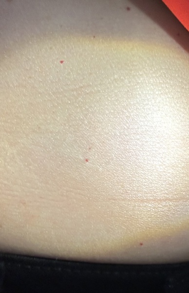 Petechiae?? But normal bloods?