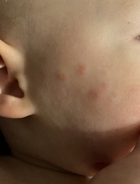 Rash on face