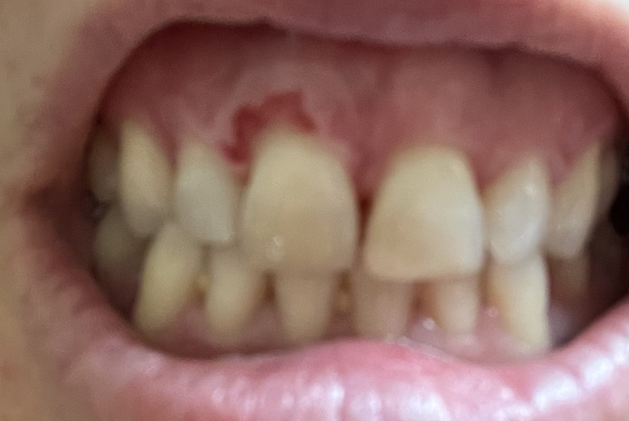 My gum!!! Picture and gross.