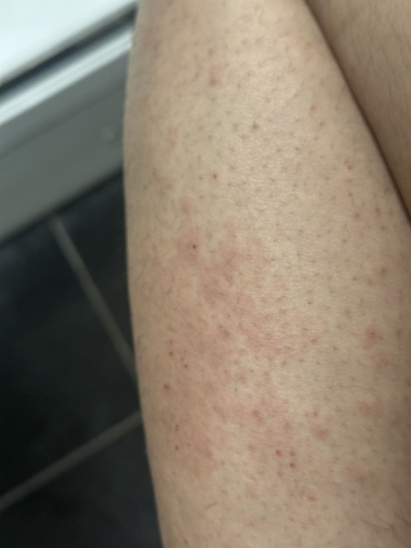Spots/all over rash
