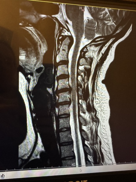 Cervical spinal stenosis