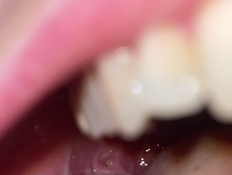 Hole In Gum (Gross picture included)