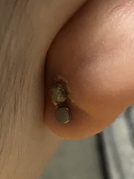 Weird crusty lump next to piercing! (Photo attached)