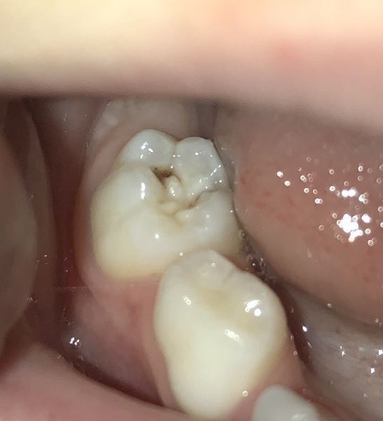Toddler molar problem potentially