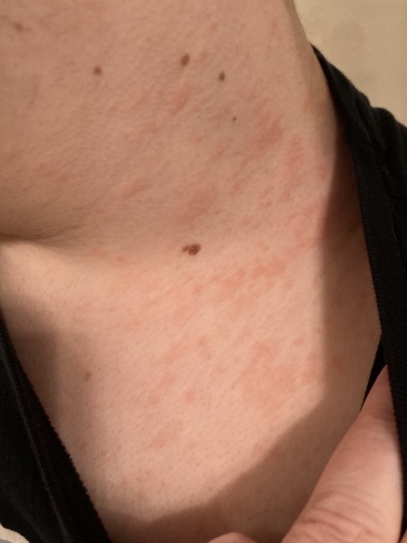 What Is this RASH ?? Photo Inc.