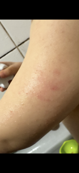 Rash on my toddler