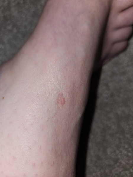 New Red mark on skin - would you see the doctor ?