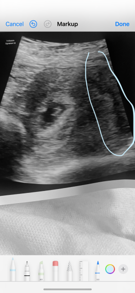 Septum uterus