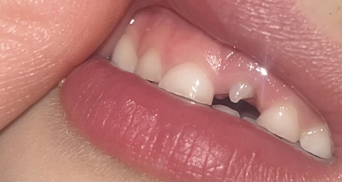 Child’s Adult Tooth Pegged