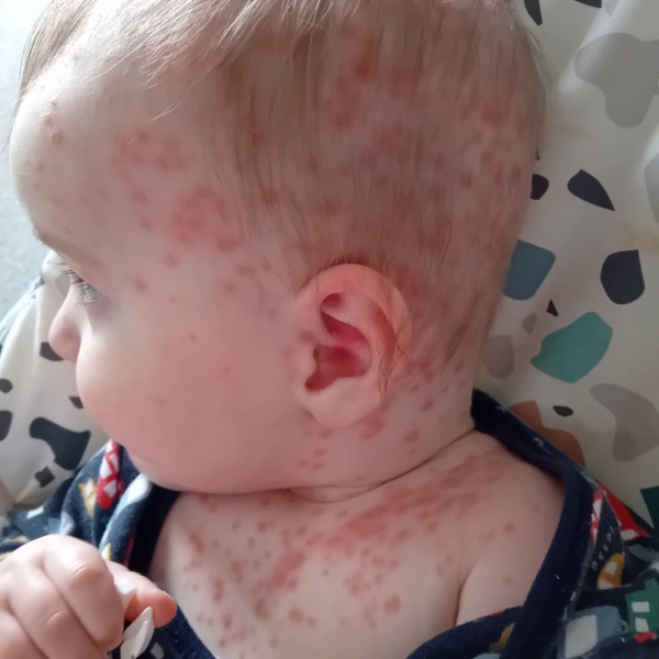 Really bad chickenpox - 9 month old advice please?
