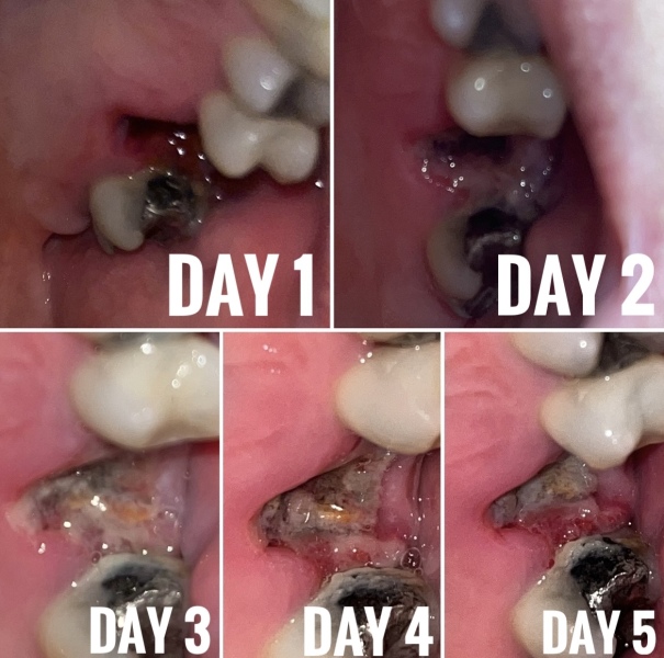 Tooth extraction still hurting & swollen on day 9?