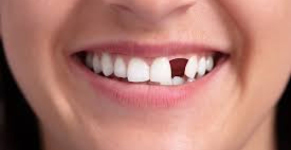 To be annoyed with my husband over his tooth