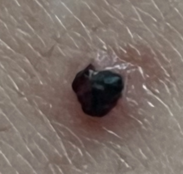 Melanoma