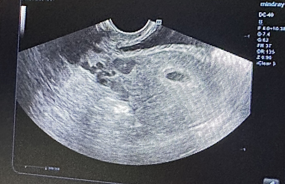 Possible molar pregnancy