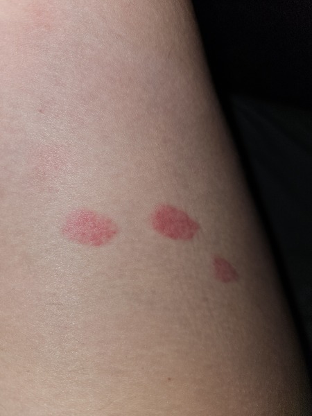 Who wants to play a game????? Guess the rash